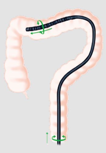 下部消化管内視鏡検査（大腸カメラ）とは