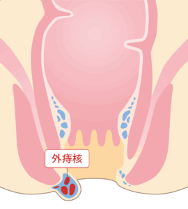 外痔核（がいじかく）