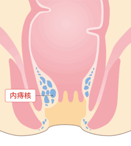 内痔核（ないじかく）