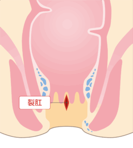 裂肛（れっこう）