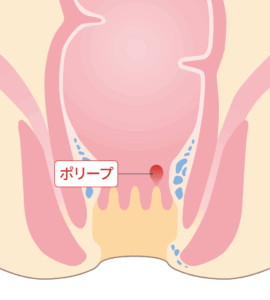 肛門ポリープ